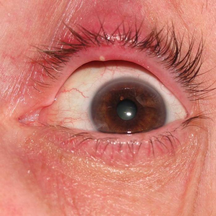 Kaip gydyti miežius viršutiniame akies vase?